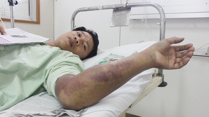 Bệnh nhân Hoàng Minh Quang đang được điều trị tại khoa Hồi sức cấp cứu, bệnh viện TW Huế.