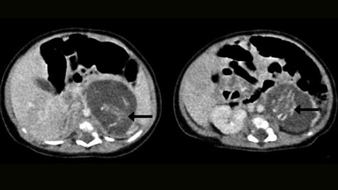 Chỗ mũi tên đánh dấu là xương sống của 2 thai nhi.