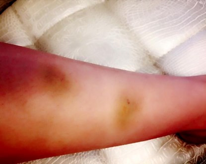 Vết bầm khắp chân của Khánh My.