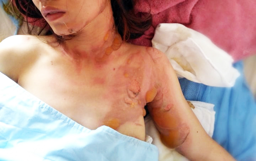 Nạn nhân bị bỏng nặng