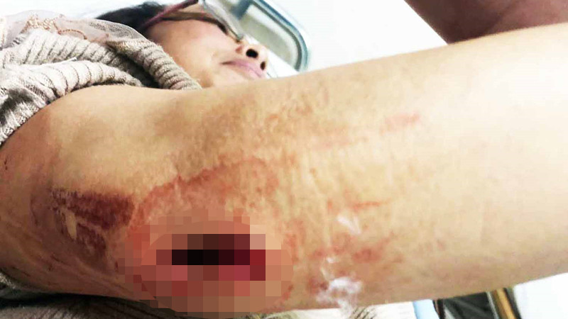 Nạn nhân bị thương, phải vào bệnh viện cấp cứu