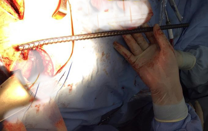 Thanh sắt lấy ra từ lồng ngực nạn nhân