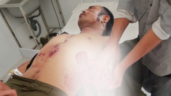 N.H.S bị dập nát bàn tay trái.