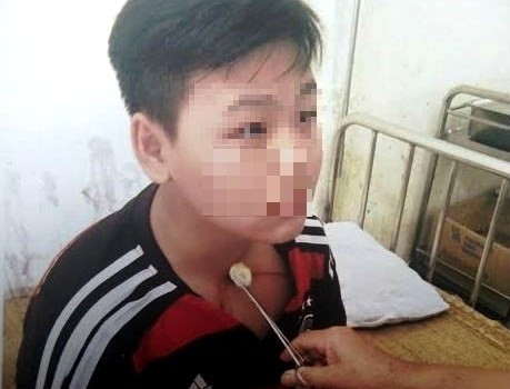 Em Tình bị thương tích phải điều trị do thầy Cầu hành hung. Ảnh: N.D. 