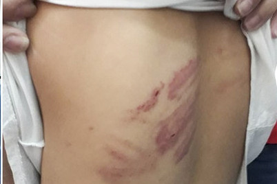 Nhiều vết thương trên người bé gái.