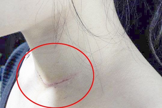 Vết thương trên cổ nạn nhân. Ảnh: CTV.