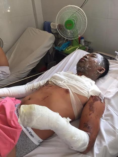 Ông tâm bị phỏng nặng đang nằm điều trị tại bệnh viện Chợ Rẫy, TP.HCM