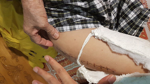 Cháu bé bị gãy chân do taxi đâm tại Trường Tiểu học Nam Trung Yên