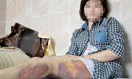 Những vết sưng bầm trên chân chị Thu