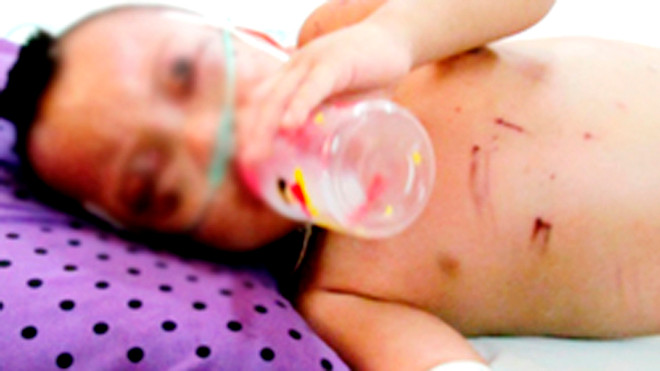 Bé Khôi sau 3 ngày được điều trị. Ảnh: Phúc Hưng