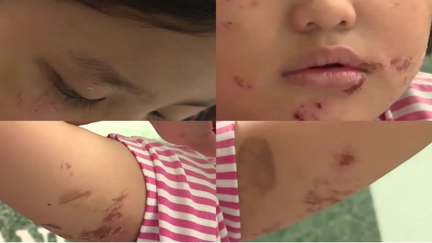 Những vết thương dày đặc trên cơ thể bé gái 6 tuổi