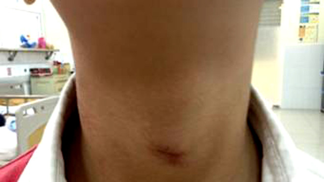 Vết thương trên cổ cháu do dây rèm cửa thít. Ảnh: Ngô Anh Vinh