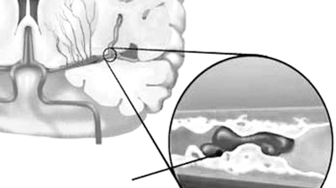 Huyết ứ gây thiếu máu não