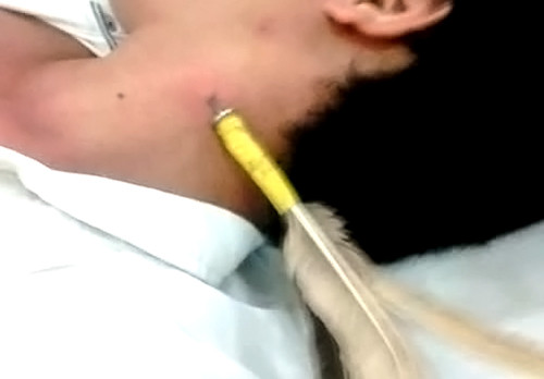 Cây phi tiêu ghim vào cổ anh Trung. Ảnh: Mai Linh.