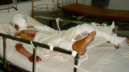 Bỏng thường để lại các di chứng ảnh hưởng đến cuộc sống của trẻ về sau. Ảnh minh họa: Thiên Chương