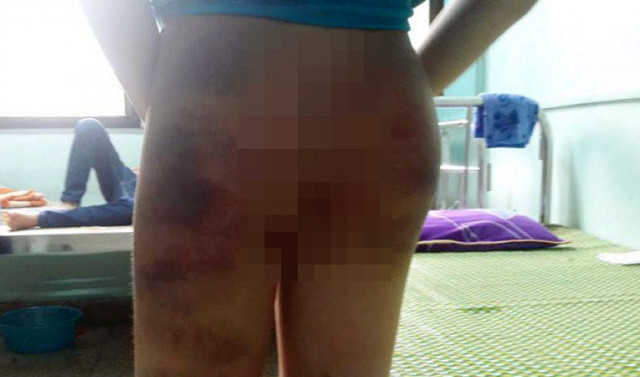 Những vết bầm tím trên cơ thể cháu H. N.