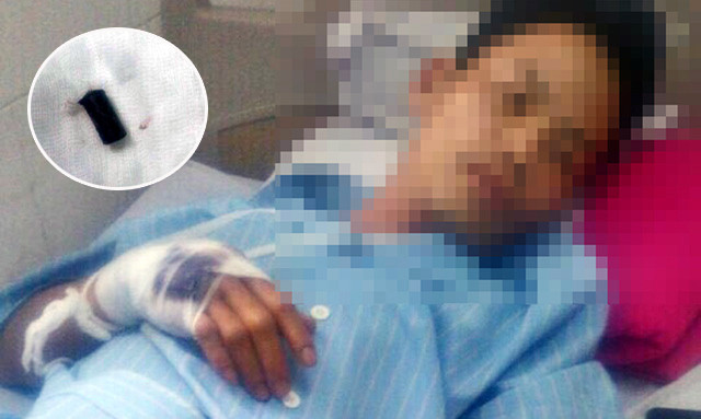 Anh T. đang được điều trị tại BV Chấn thương chỉnh hình Nghệ An và viên đạn cao su được gắp ra từ tay anh T.