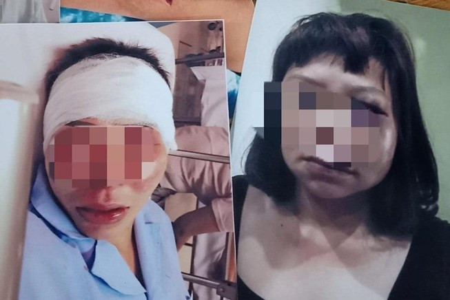 Chị Hạnh bị chồng bạo hành dã man