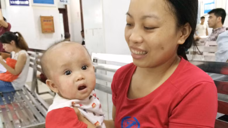 Bệnh nhi Khánh Vy bị viêm da cơ địa. Ảnh T.Hà