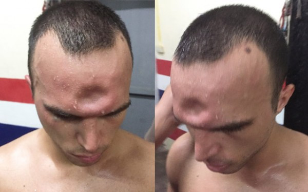 Jeremy bị lõm trán sau khi lĩnh trọn cú thúc cùi chỏ của đối thủ.