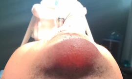 Cằm của nam Việt kiều 'phát sáng' khiến ê kíp phẫu thuật tá hỏa