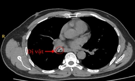 Ho triền miên suốt một năm vì hạt trái cây 'đi lạc' trong phổi