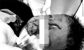 Bé trai 5 tuổi bị chó béc giê nhà hàng xóm cắn nát mặt