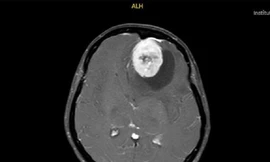 Người phụ nữ bị u màng não khổng lồ, bác sĩ chỉ ra những dấu hiệu dễ nhầm lẫn