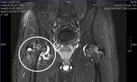Bác sĩ ngoại quốc chẩn đoán sai, Việt kiều về nước được điều trị khỏi bệnh 
