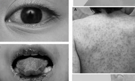 Trẻ mắc bệnh hiếm gặp gây đột tử, bác sĩ chẩn đoán bị... viêm họng