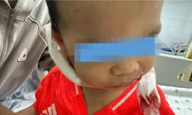 Bé trai 2 tuổi bị chó nhà nuôi cắn nhiều vết trên mặt