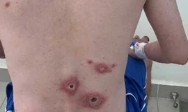 Nam nhân viên văn phòng lở loét toàn thân vì quan hệ tình dục bừa bãi