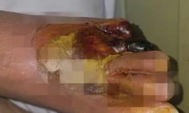 Bàn chân bị cháy đen vì sưởi ấm bằng máy sấy tóc