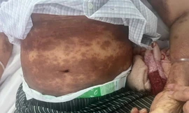 Tự ý mua thuốc điều trị, bệnh nhân hoại tử da nhiễm độc nặng