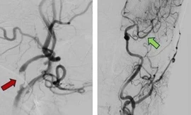 Cứu sống cụ ông gần trăm tuổi bị đột quỵ vượt xa 'giờ vàng'