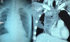 ‘U quái’ chèn tim, ép phổi suýt đoạt mạng nam sinh viên