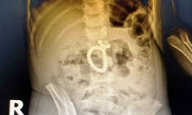 Bé trai thủng ruột 8 lỗ vì món đồ chơi nhiều trẻ thích mê mẩn