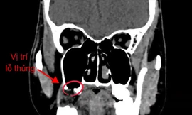 Nhổ 'răng khôn', người đàn ông bị đục thủng xoang hàm