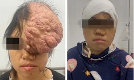 Giải cứu cô gái trẻ thoát khỏi khối 'bướu quỷ' trên đầu và mặt