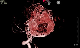 Chàng trai trẻ đau đầu kinh niên vì mạch máu não 'rối như tơ vò'