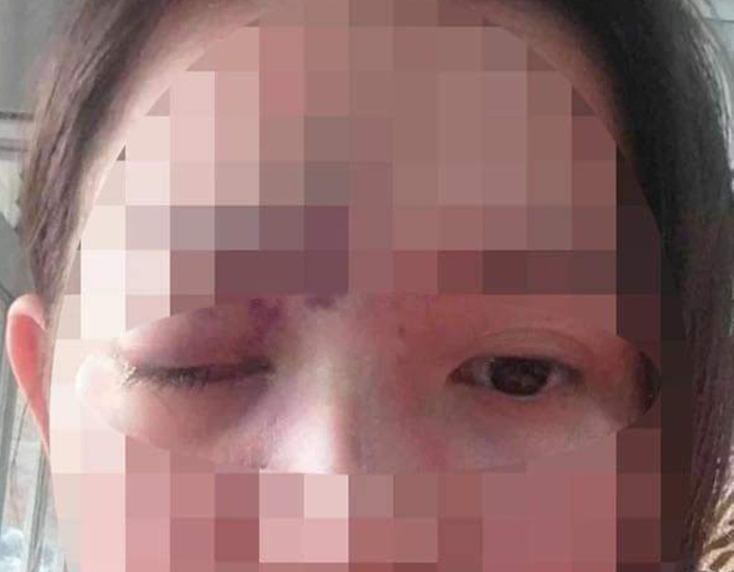 Chị T. với mắt trái bị giảm thị lực sau khi tiêm filler Chị T. với mắt trái bị giảm thị lực sau khi tiêm filler