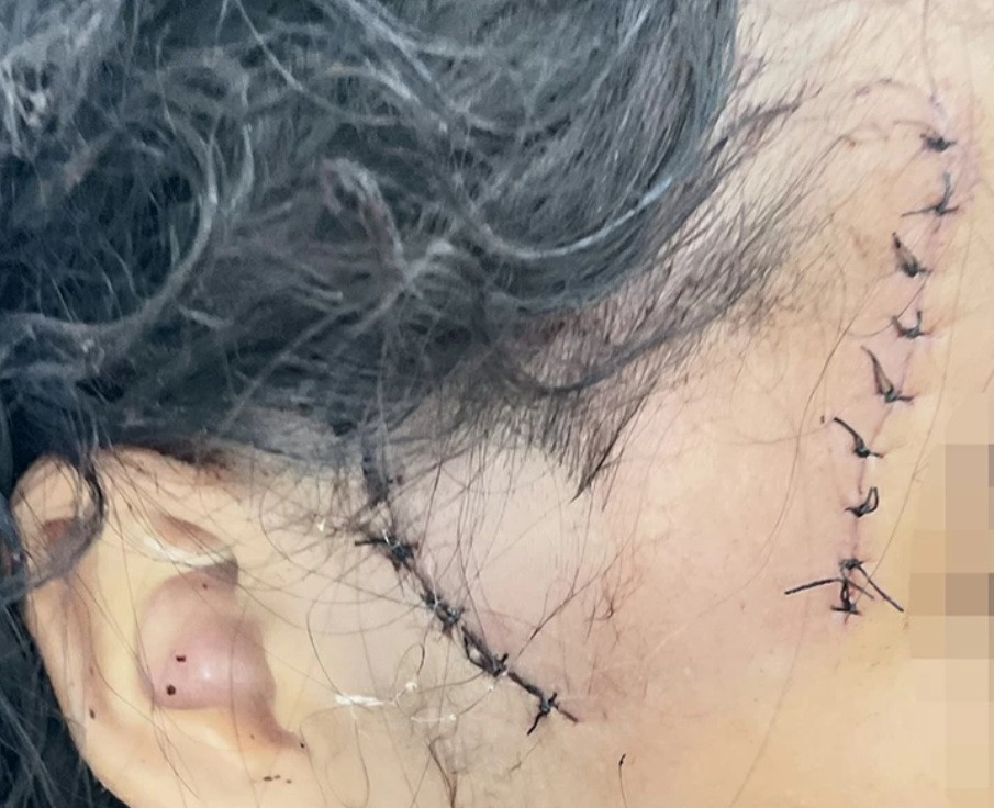 Cháu A. bị chém gây thương tích ở vùng mặt