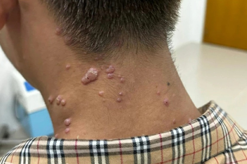 Triệu chứng mắc đậu mùa khỉ ở bệnh nhân