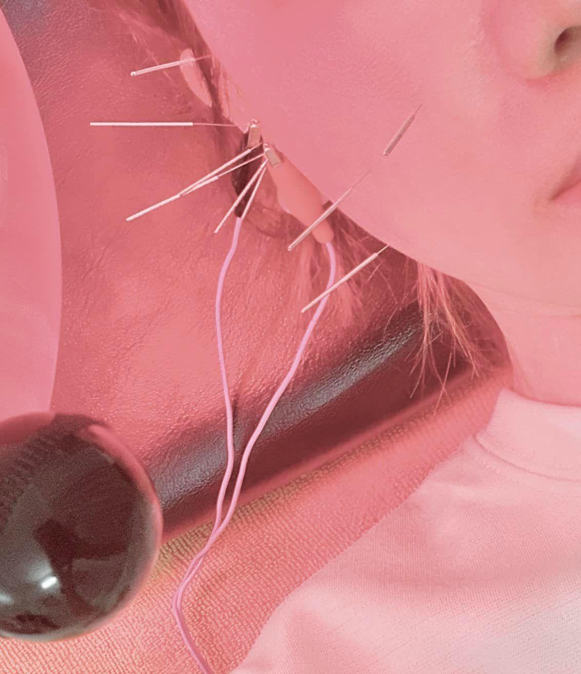 Cô đăng tải hình ảnh bản thân điều trị bằng châm cứu trên mạng xã hội. - Ảnh: FBNV Cô đăng tải hình ảnh bản thân điều trị bằng châm cứu trên mạng xã hội. - Ảnh: FBNV