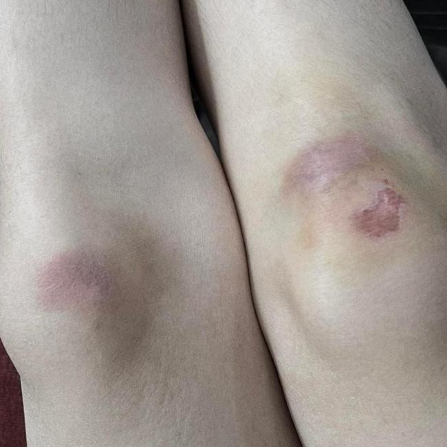 Bức ảnh bị thương của Sơn Tùng nhận hơn 17 ngàn lượt tương tác. - Ảnh: FBNV. Bức ảnh bị thương của Sơn Tùng nhận hơn 17 ngàn lượt tương tác. - Ảnh: FBNV.