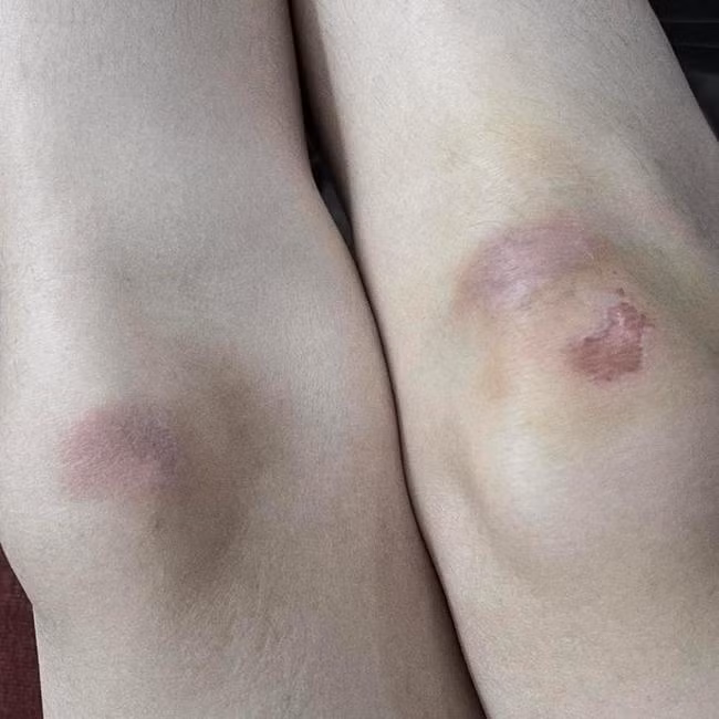 Bức ảnh bị thương của Sơn Tùng nhận hơn 17 ngàn lượt tương tác. - Ảnh: FBNV.