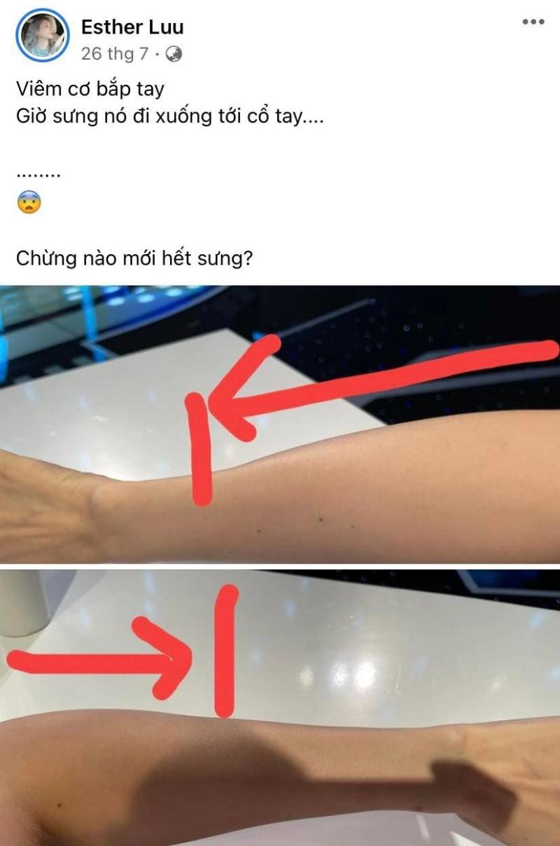 Ban đầu, Hari Won được chuẩn đoán bị viêm cơ tay. - Ảnh: FBNV Ban đầu, Hari Won được chuẩn đoán bị viêm cơ tay. - Ảnh: FBNV