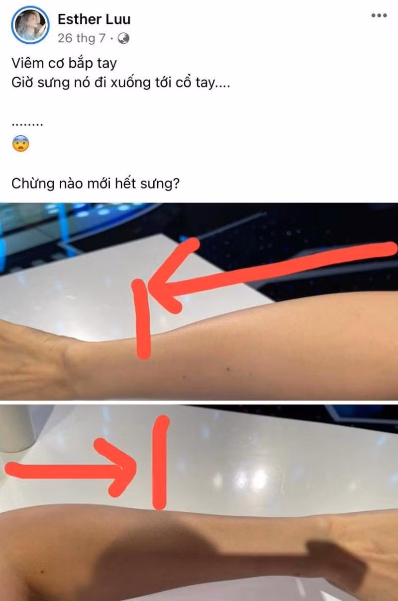 Ban đầu, Hari Won được chuẩn đoán bị viêm cơ tay. - Ảnh: FBNV