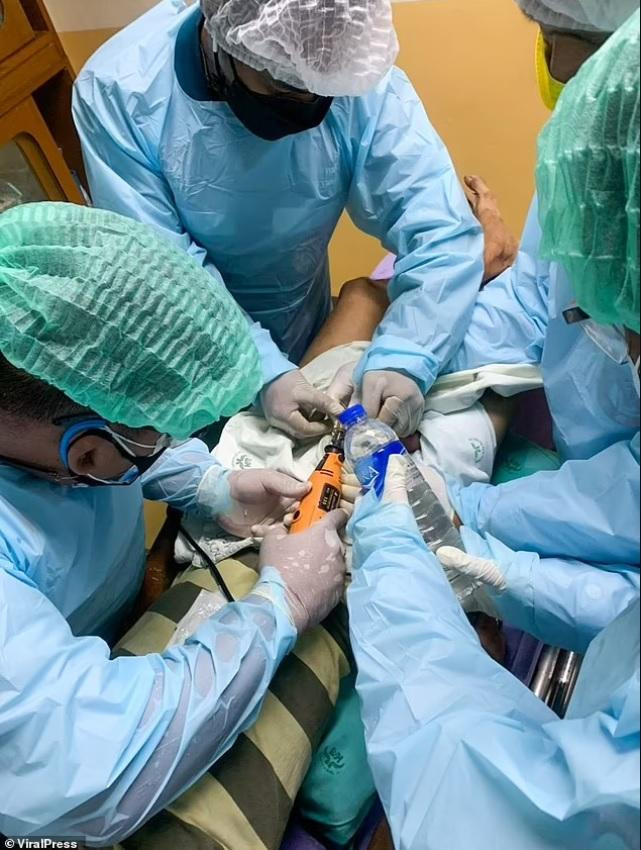 Các bác sĩ đã dành hơn 30 phút, sử dụng một máy cắt điện để cắt ổ khóa kim loại ra khỏi dương vật đang sưng tấy. Ảnh: Viral Press Các bác sĩ đã dành hơn 30 phút, sử dụng một máy cắt điện để cắt ổ khóa kim loại ra khỏi dương vật đang sưng tấy. Ảnh: Viral Press