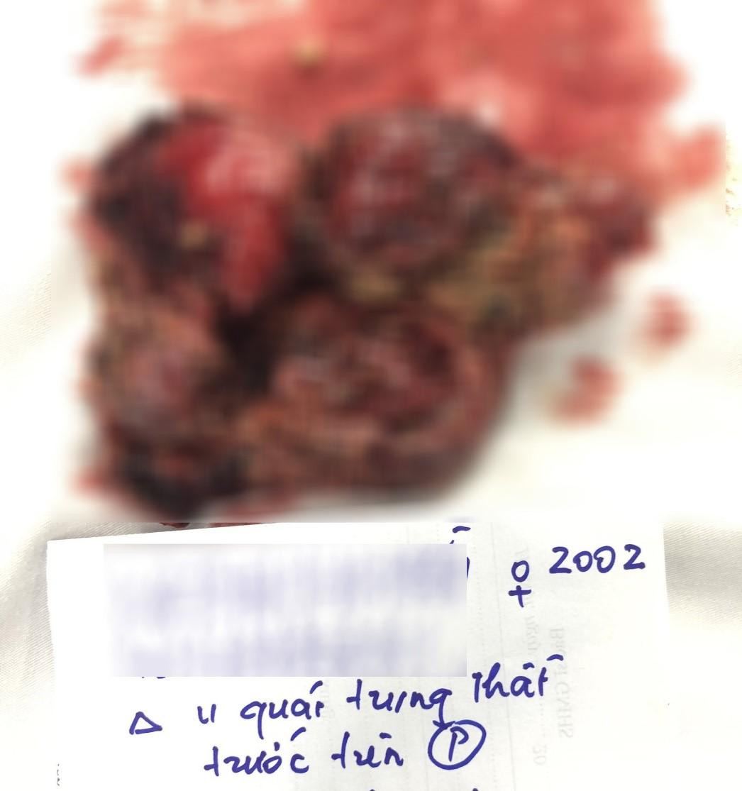 Khối u quái sau khi được cắt bỏ Khối u quái sau khi được cắt bỏ